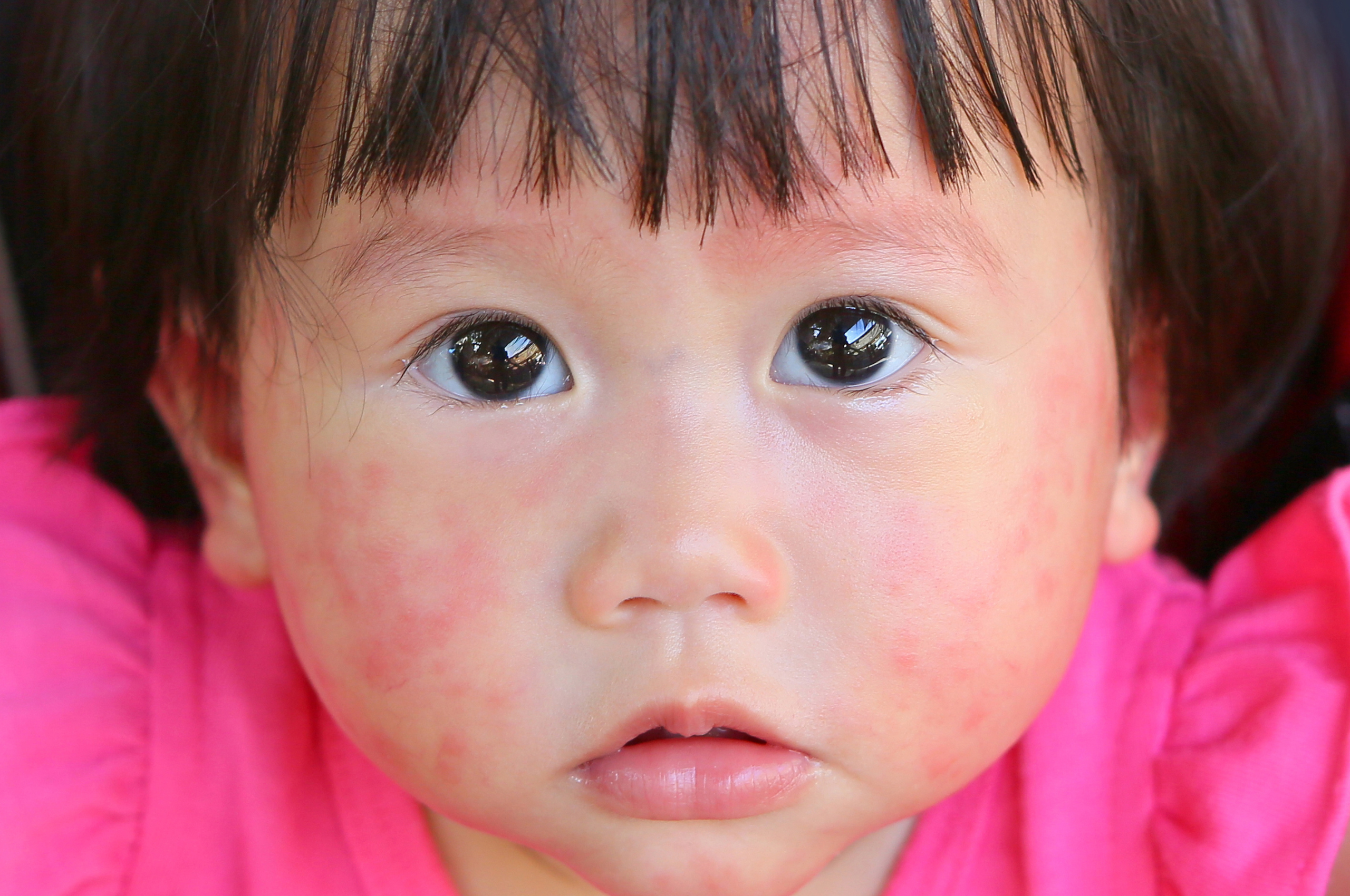 heal pediatric eczema